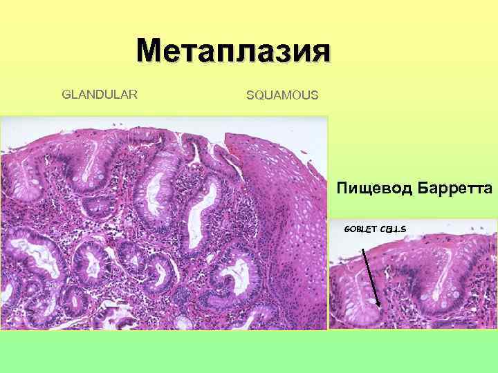 Метаплазия GLANDULAR SQUAMOUS Пищевод Барретта GOBLET CELLS 