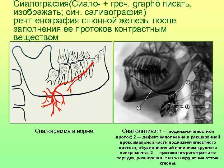 Сиалография(Сиало- + греч. graphō писать, изображать; син. саливография) рентгенография слюнной железы после заполнения ее
