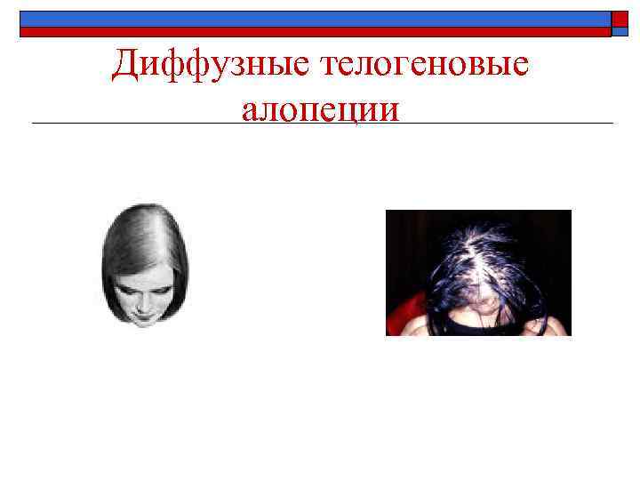Диффузные телогеновые алопеции 