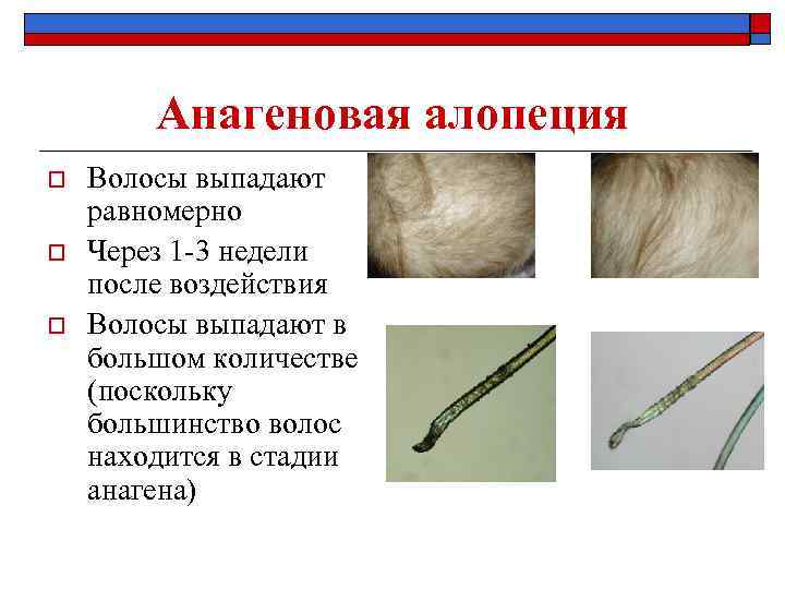 Анагеновая алопеция o o o Волосы выпадают равномерно Через 1 -3 недели после воздействия