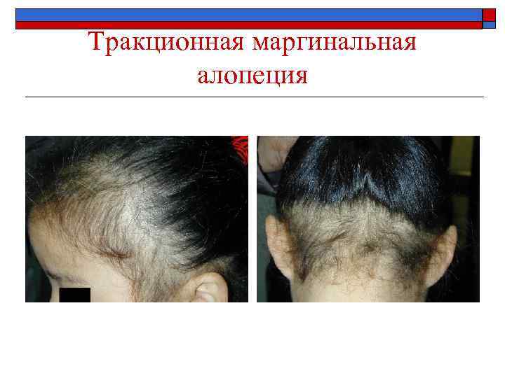 Тракционная маргинальная алопеция 