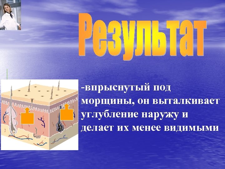 -впрыснутый под морщины, он выталкивает углубление наружу и делает их менее видимыми 