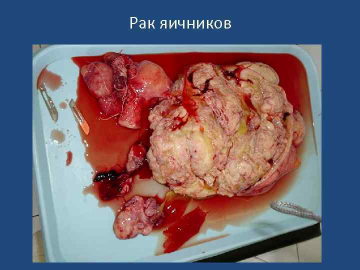 Рак яичников 