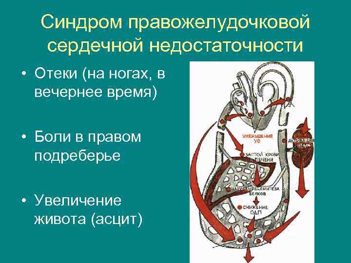 Синдром правожелудочковой сердечной недостаточности • Отеки (на ногах, в вечернее время) • Боли в