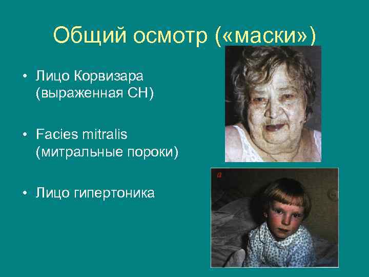 Общий осмотр ( «маски» ) • Лицо Корвизара (выраженная СН) • Facies mitralis (митральные