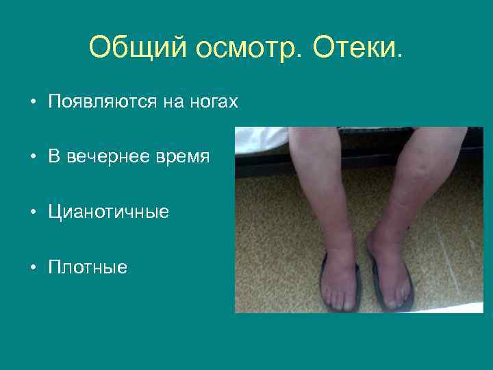 Общий осмотр. Отеки. • Появляются на ногах • В вечернее время • Цианотичные •