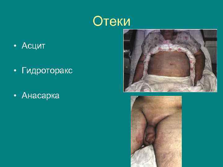 Отеки • Асцит • Гидроторакс • Анасарка 