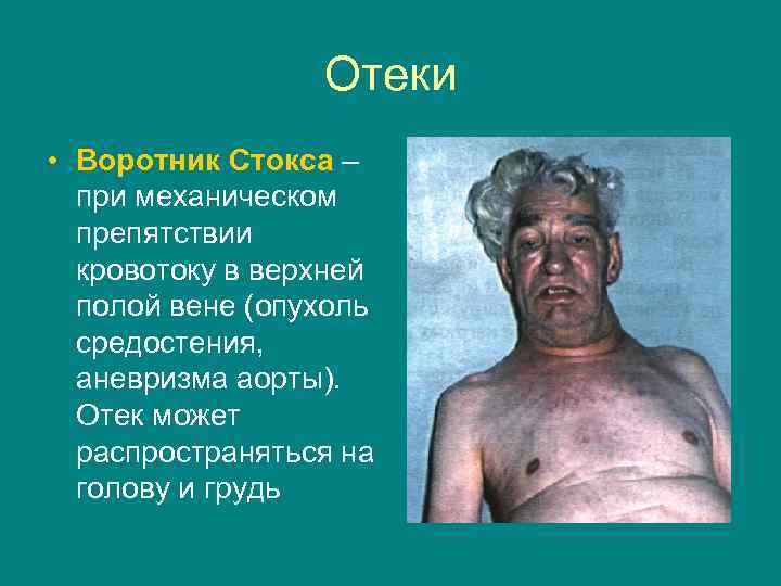 Отеки • Воротник Стокса – при механическом препятствии кровотоку в верхней полой вене (опухоль