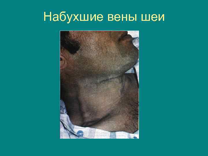 Набухшие вены шеи 