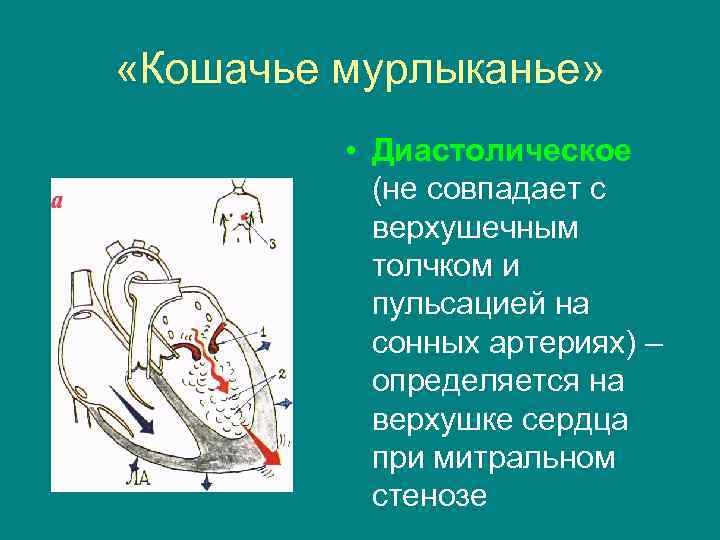  «Кошачье мурлыканье» • Диастолическое (не совпадает с верхушечным толчком и пульсацией на сонных