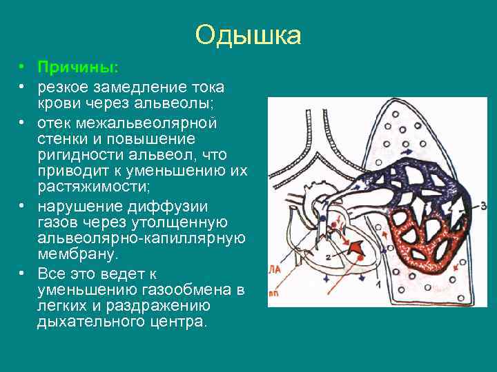 Одышка • Причины: • резкое замедление тока крови через альвеолы; • отек межальвеолярной стенки