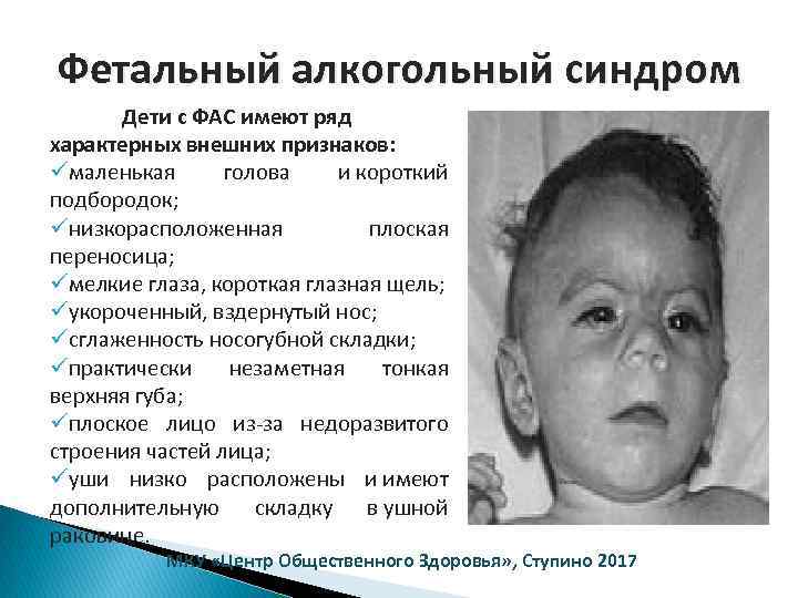 Фетальный алкогольный синдром Дети с ФАС имеют ряд характерных внешних признаков: üмаленькая голова и