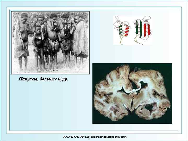 Папуасы, больные куру. ФГОУ ВПО ЮФУ каф. биохимии и микробиологии 