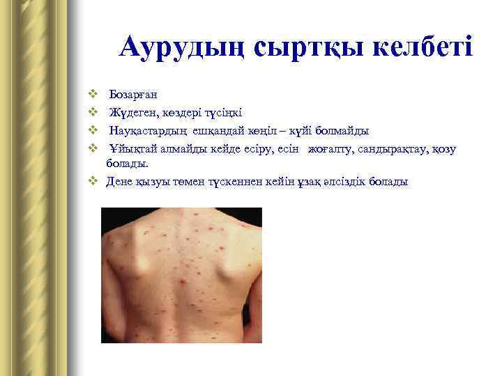 Аурудың сыртқы келбеті v v Бозарған Жүдеген, көздері түсіңкі Науқастардың ешқандай көңіл – күйі