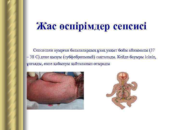 Жас өспірімдер сепсисі Сепсиспен ауырған балалалардың ұзақ уақыт бойы айнымалы (37 – 38 С)