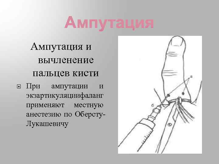 Ампутация и вычленение пальцев кисти При ампутации и экзартикуляциифаланг применяют местную анестезию по Оберсту.