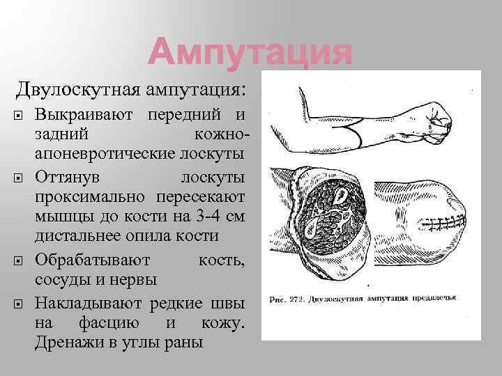 Двулоскутная ампутация: Выкраивают передний и задний кожноапоневротические лоскуты Оттянув лоскуты проксимально пересекают мышцы до