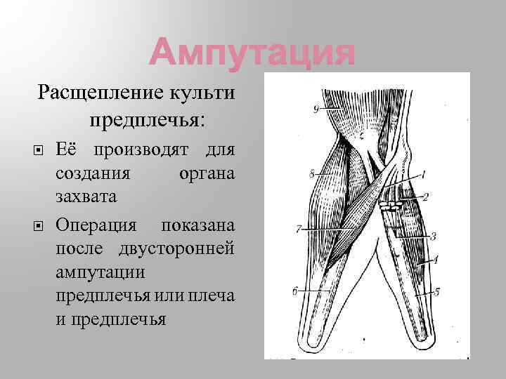 Ампутация плеча презентация