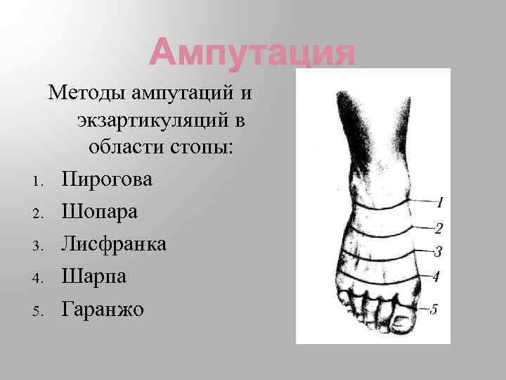 Методы ампутаций и экзартикуляций в области стопы: 1. Пирогова 2. Шопара 3. Лисфранка 4.