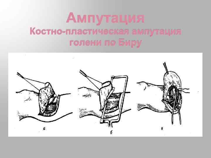 Костно-пластическая ампутация бедра по Гритти-Шимановскому. Ампутация бедра по Гритти-Шимановскому-Альбрехту. Ампутация голени по Гритти. Ампутация голени фасциопластическим методом.