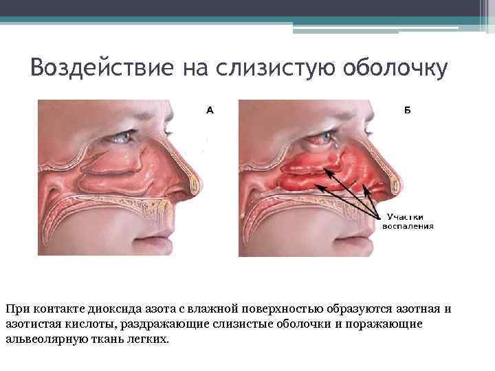 Воздействие на слизистую оболочку При контакте диоксида азота с влажной поверхностью образуются азотная и
