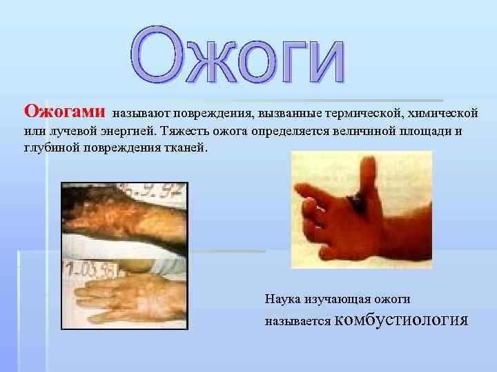 Ожогами называют повреждения, вызванные термической, химической или лучевой энергией. Тяжесть ожога определяется величиной площади