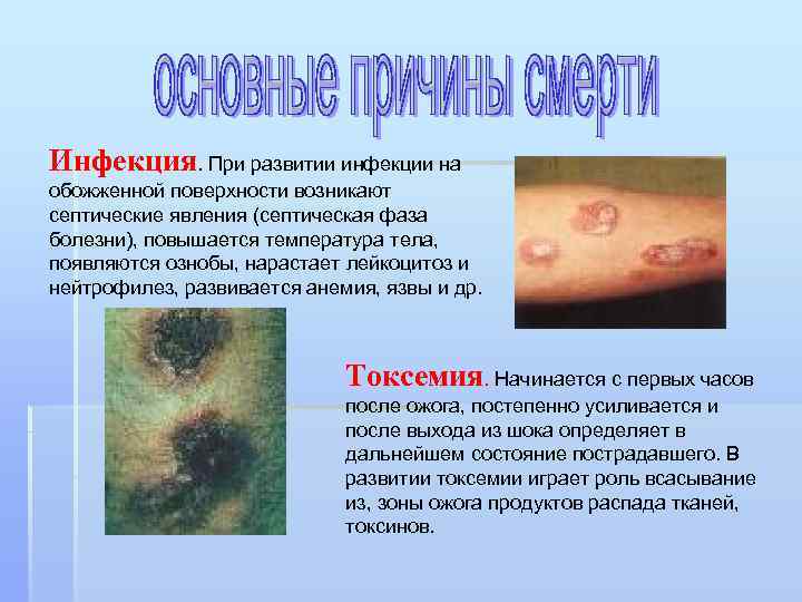 Инфекция. При развитии инфекции на обожженной поверхности возникают септические явления (септическая фаза болезни), повышается