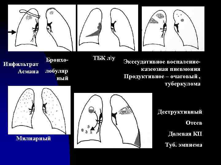 Инфильтрат Асмана Бронхолобуляр ный ТБК лу Экссудативное воспалениеказеозная пневмония Продуктивное – очаговый , туберкулома