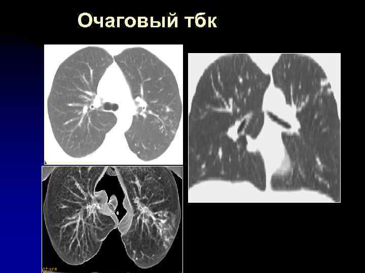 Очаговый тбк 