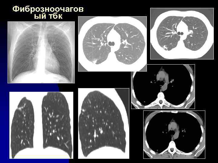 Фиброзноочагов ый тбк 