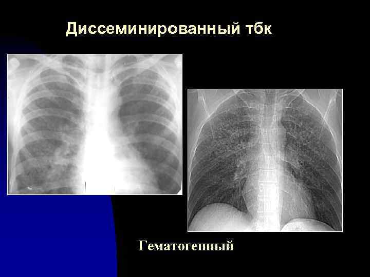 Диссеминированный тбк Гематогенный 