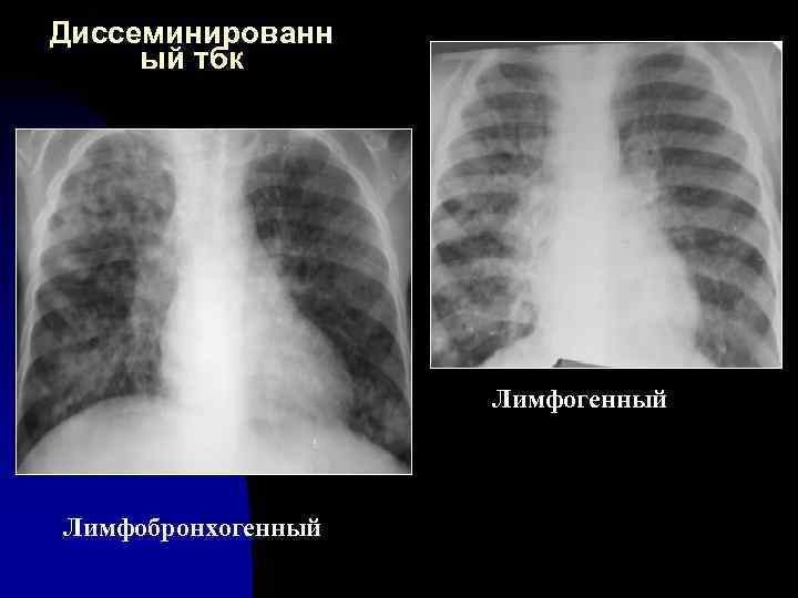 Диссеминированн ый тбк Лимфогенный Лимфобронхогенный 