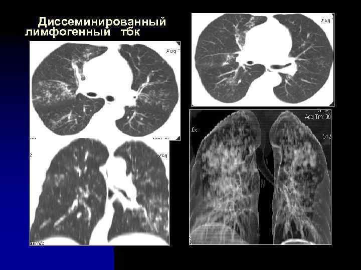 Диссеминированный лимфогенный тбк 
