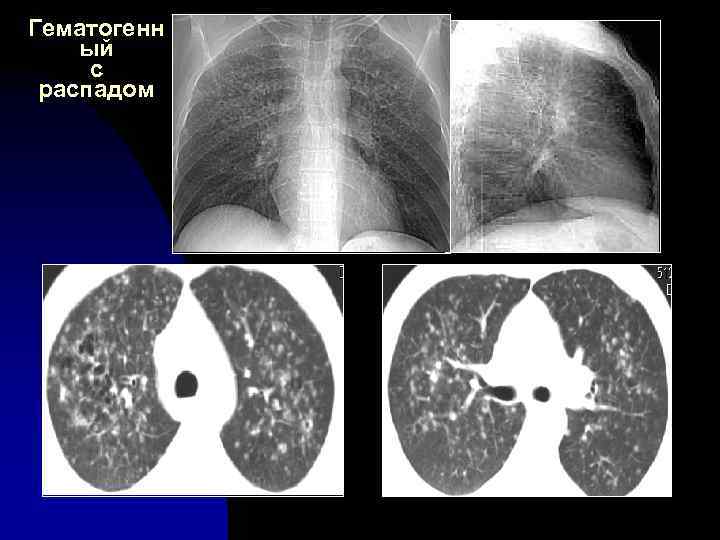 Гематогенн ый с распадом 