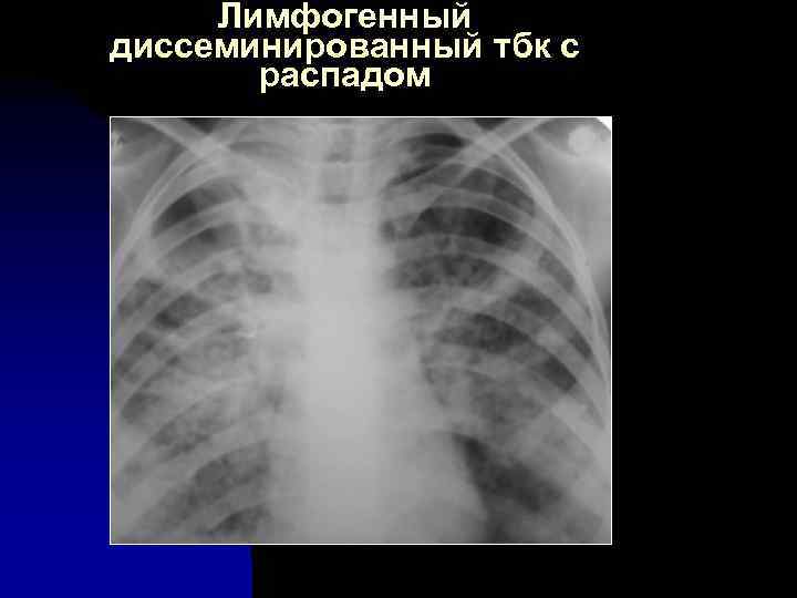 Лимфогенный диссеминированный тбк с распадом 