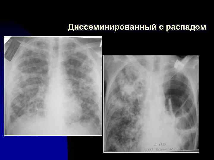 Диссеминированный с распадом 