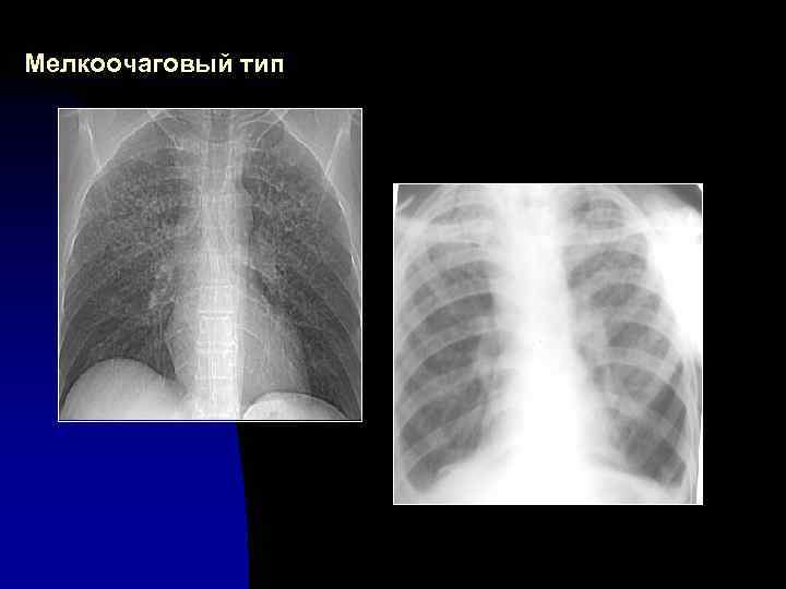 Мелкоочаговый тип 