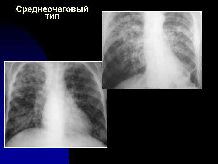Среднеочаговый тип 