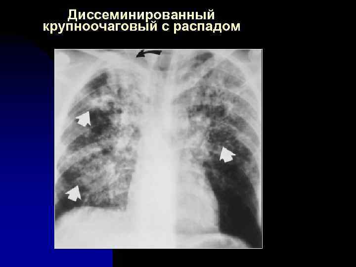 Диссеминированный крупноочаговый с распадом 