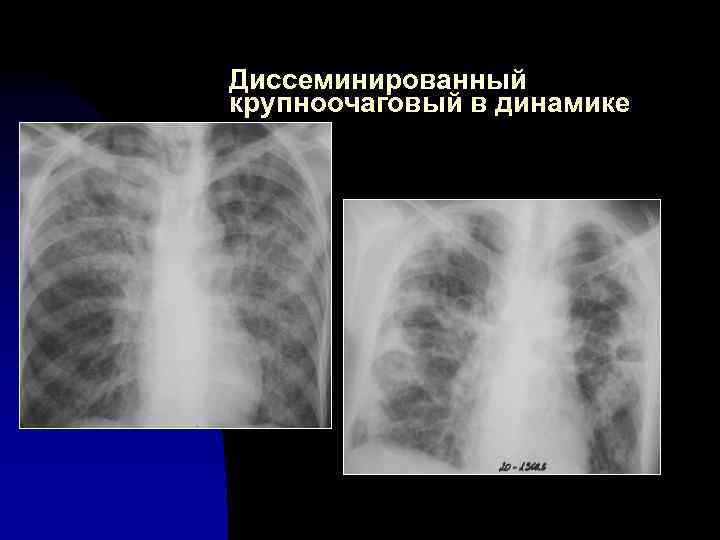 Диссеминированный крупноочаговый в динамике 