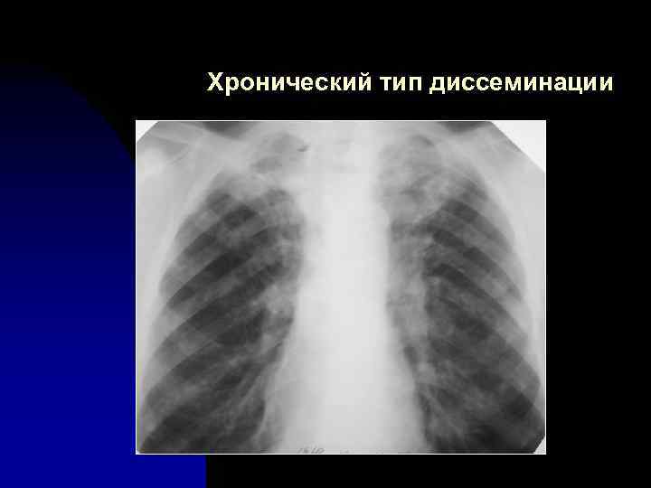 Хронический тип диссеминации 