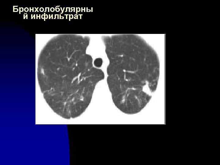 Бронхолобулярны й инфильтрат 