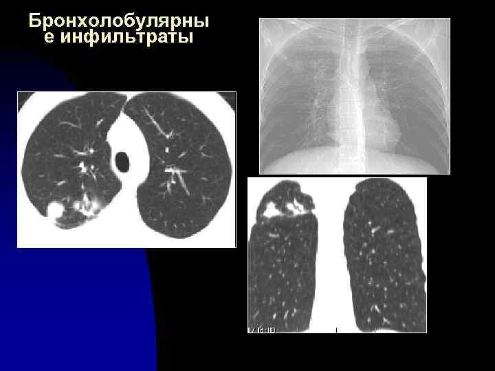 Бронхолобулярны е инфильтраты 
