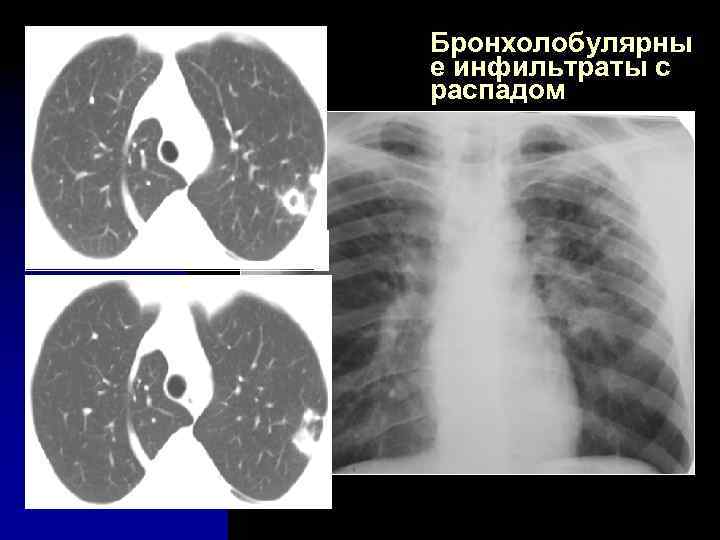 Бронхолобулярны е инфильтраты с распадом 