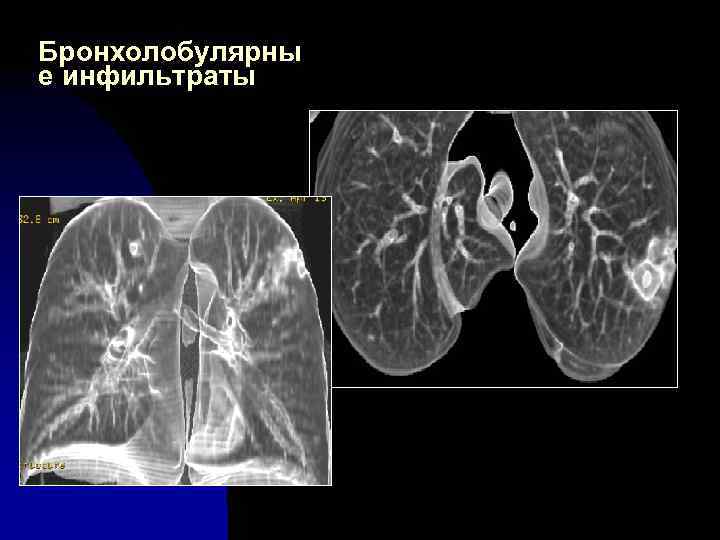 Бронхолобулярны е инфильтраты 