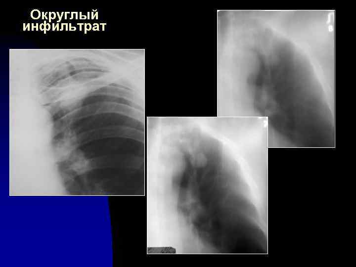 Округлый инфильтрат 