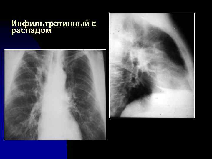 Инфильтративный с распадом 