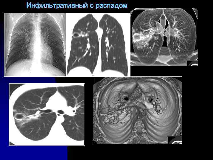 Инфильтративный с распадом 