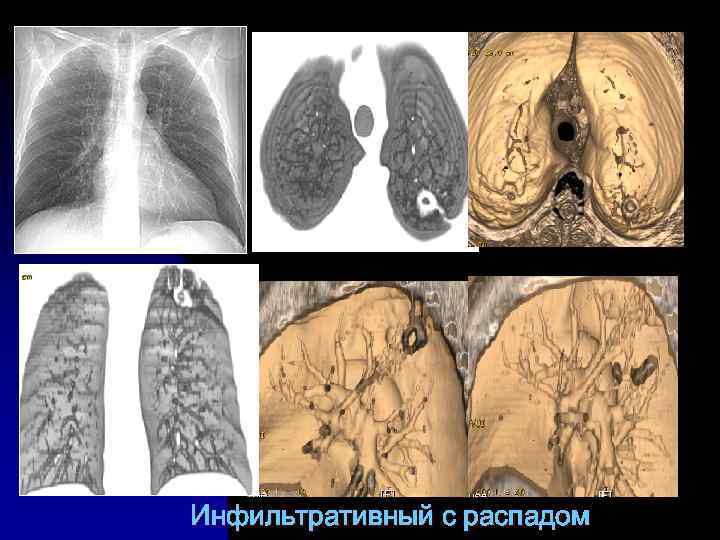 Инфильтративный с распадом 