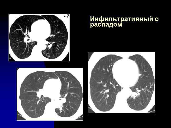 Инфильтративный с распадом 